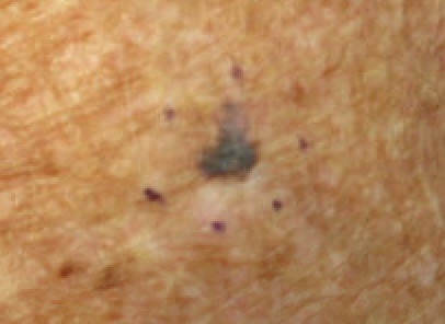 Clinical lesion of malignant melanoma
