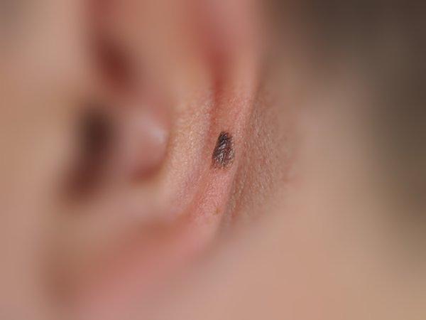 Clinical macroscopic photograph of invasive melanoma on the ear
