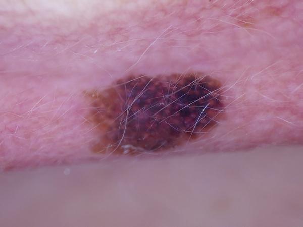 Dermoscopy image of invasive melanoma on the ear
