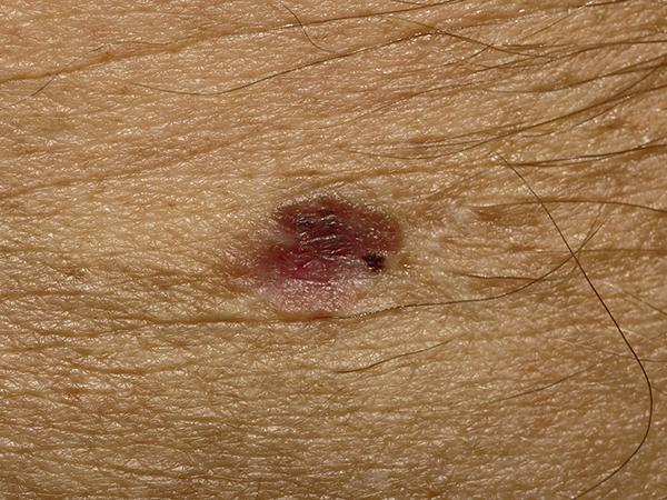 Dermoscopy image of amelanotic invasive melanoma